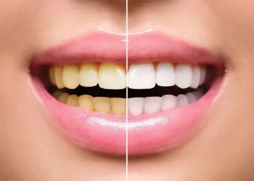 Cleaning & Whitening